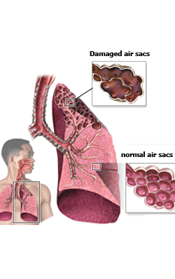 chronic-obstructive-pulmonary-disease-introduction-common-symptoms